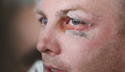 Berufsrisiko für einen Rugby-Spieler wie Darren Lockyer, aber dieses Auge ...